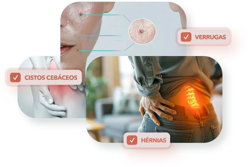 Pequenas Cirurgias Cistos Cebáceos, Verrugas E Hérnias